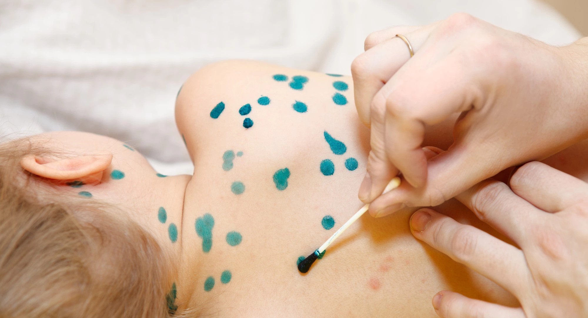 Не водите детей на ветряночные вечеринки, это опасно