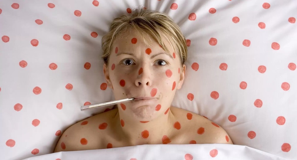 Что делать, чтобы не подхватить корь Что делать, чтобы не подхватить корь